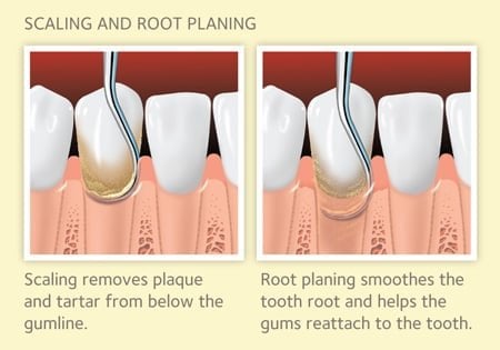 https://www.johnsfamilydentistry.com/wp-content/uploads/sites/5140/2017/06/SRP_450x315.jpg